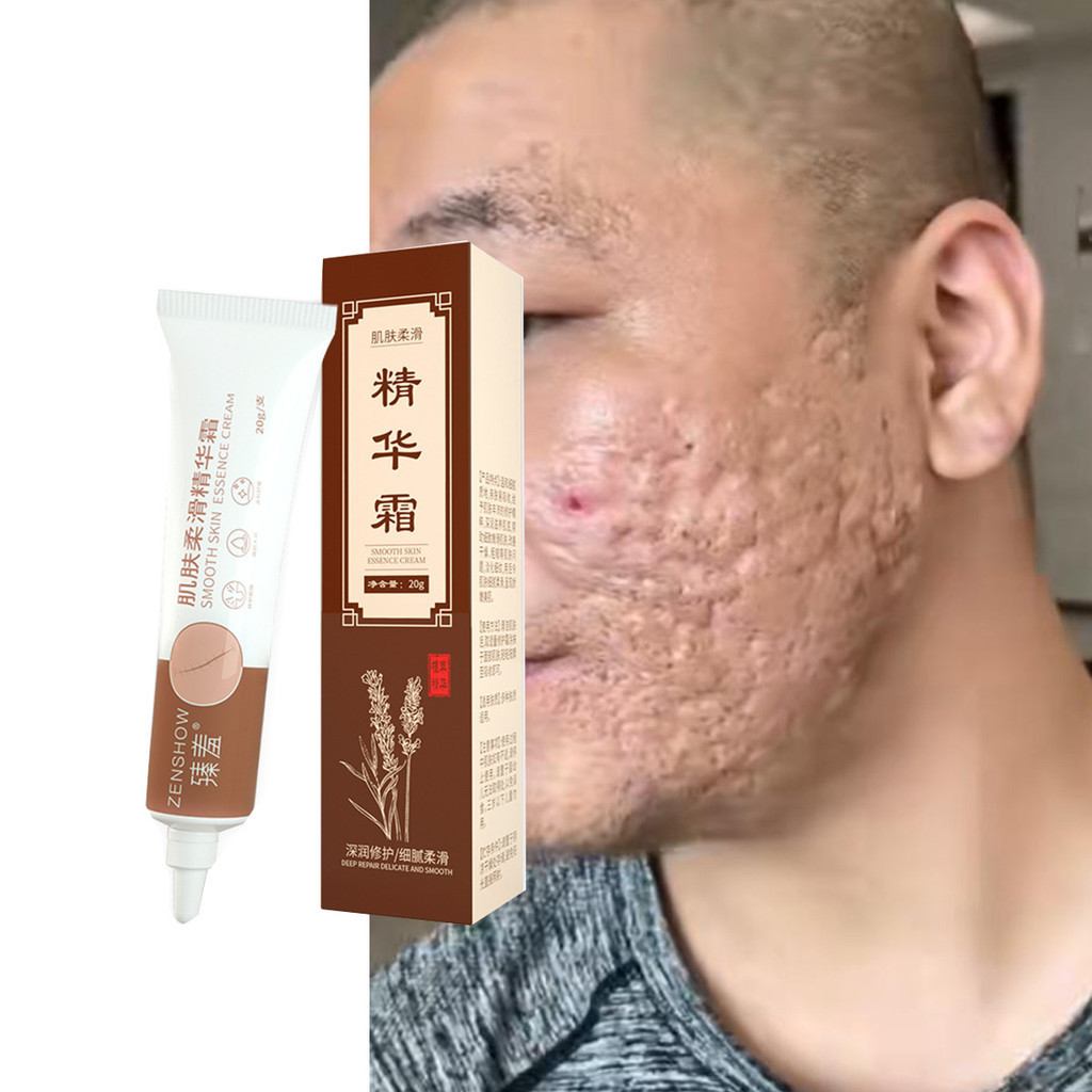 Zhenxiu สกินสมูทติ้งครีม ลดริ้วรอย เมลานิน สิว รอยแผลเป็นจากสิว