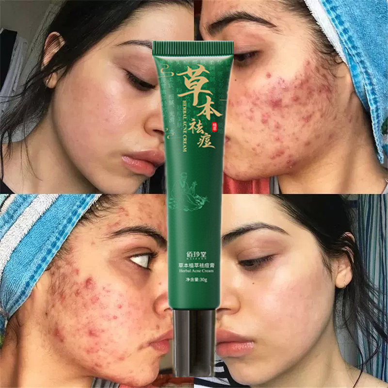 Baizton Herbal Acne Cream 30g (ครีมแต้มสิวสมุนไพร) ควบคุมความมันปรับผิวให้เรียบเนียน