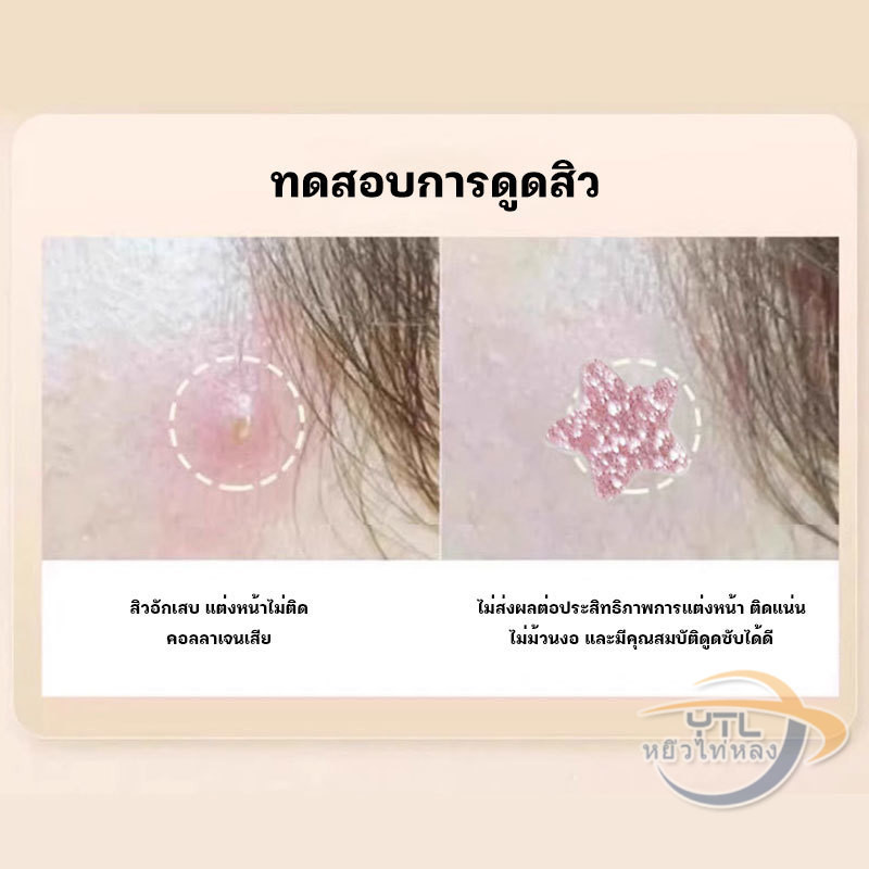 YTL แผ่นแปะสิวรูปดาว แผ่นแปะสิว ขอบบาง กันน้ำ แต่งหน้าเนียน ปกปิดรอยสิว ใช้ได้กับทุกสภาพผิว กันน้ำ ดูแลผิวหน้า 40 ชิ้น - รูปที่ 5