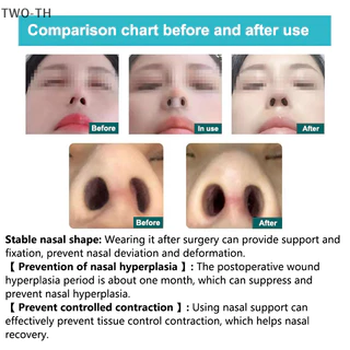 Two-th หลังผ ่ าตัดจมูกสนับสนุนซิลิโคน Shaping Crooked Nose Correction Fixator ซิลิกาเจลคลิปจมูกใหม ่