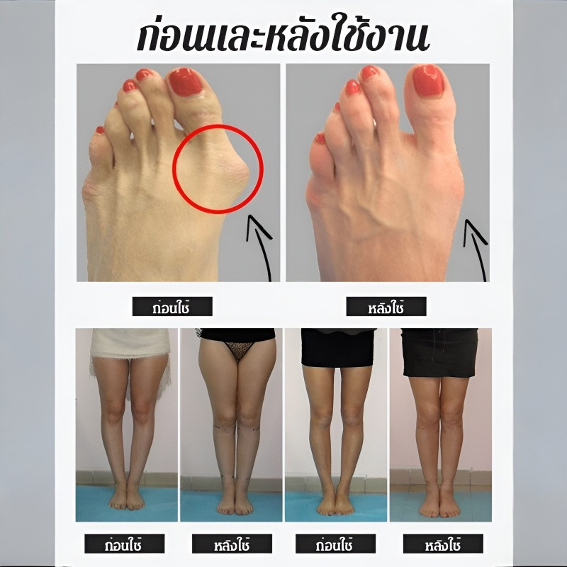 【แก้เท้าผิดรูป/วัสดุยืดหยุ่นสูง】อุปกรณ์แก้นิ้วโป้งเท้าเกผ้าตาข่าย the love ปรับรูปเท้า ระบายอากาศดี สวมใส่สบาย แก้นิ้วโป้งเบี่ยง กันลื่น ใส่ได้ในรองเท้าทุกแบบ ซักรีดซ้ำได้
