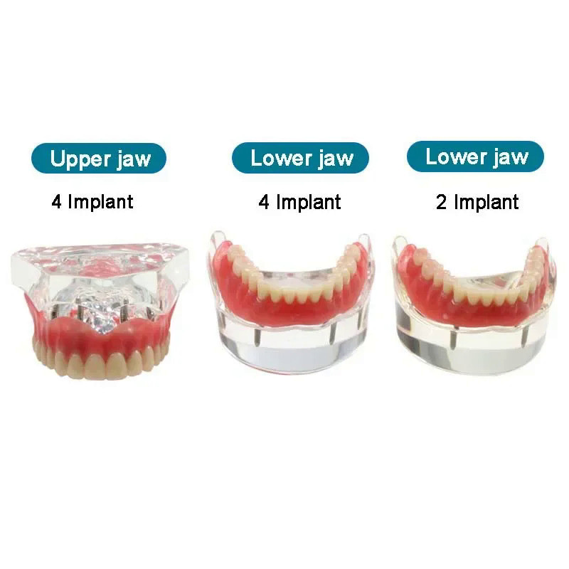 ฟันทันตกรรมรุ่นด้วย Implant Overdenture Inferior Demo Mandibular รุ่นทันตแพทย์นักเรียนการเรียนรู้รุ่น