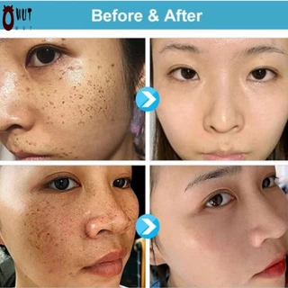 ความแรงสูงสุด Skin Tag Remover Gentle Highly Potent Wart Removal Treatment สําหรับผู้ใหญ่ Natural & Healthy Supplies