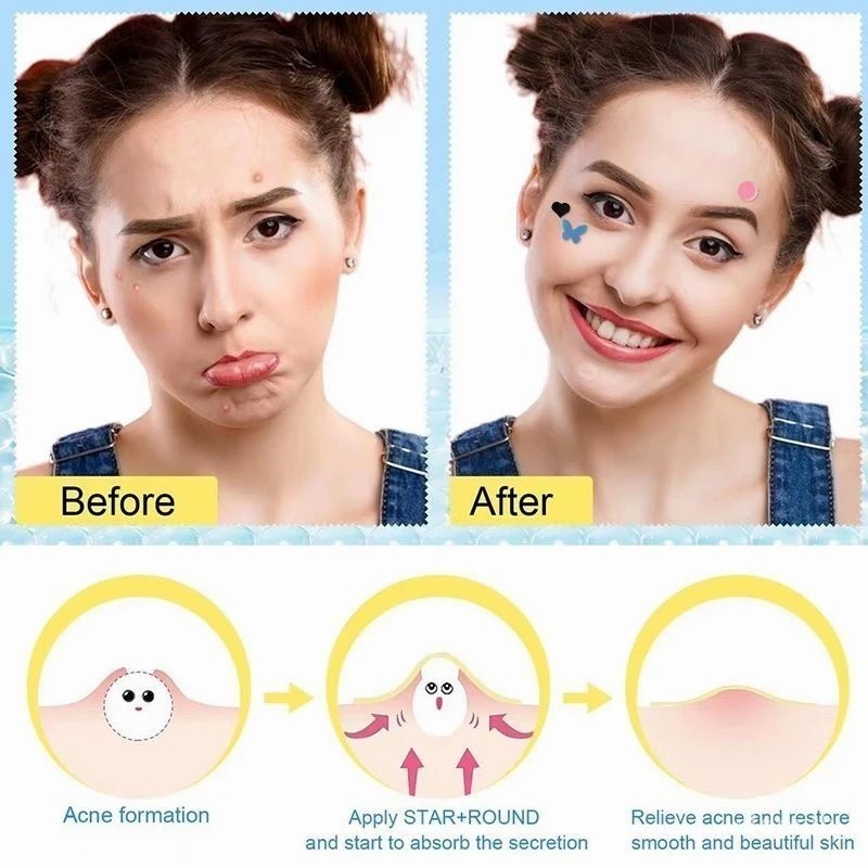 แผ่นแปะสิว สิวเสี้ยน น่ารัก แผ่นแปะสิว รูปดาว หลากสี กันน้ำ สำหรับดูแลผิว