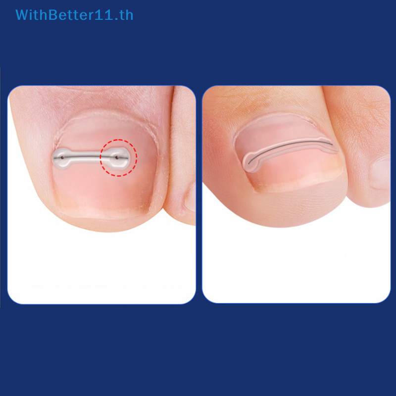 Better คุด Toenail Corrector เครื่องมือ Pedicure Recovered Toe Nail Treatment คุด Toenail Straightening คลิปรั้ง TH