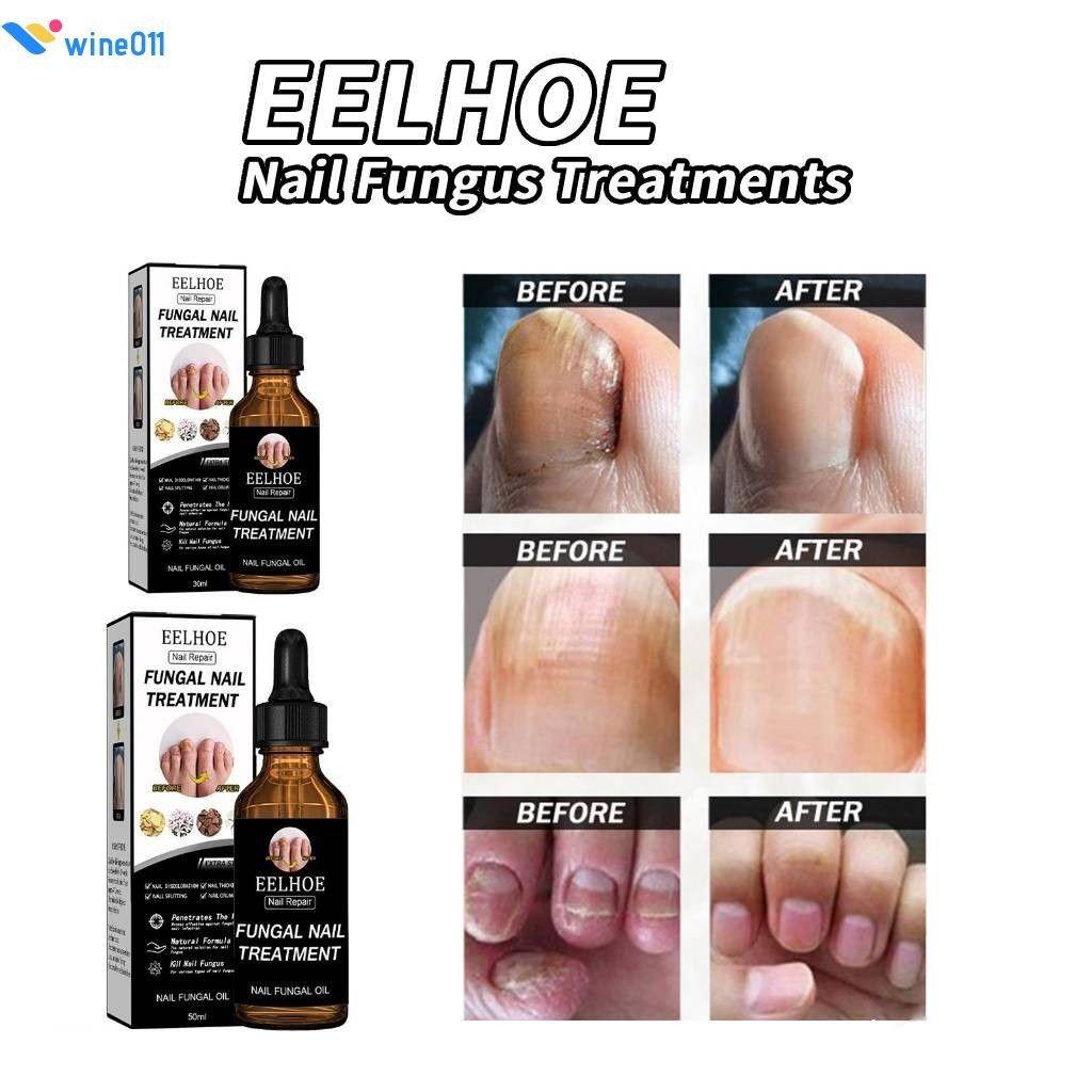 Eelhoe รา Treatment Liquid น้ำมันเชื้อราเล็บหยุดเชื้อรา Growth เชื้อราเล็บกำจัดมือและเท้าเล็บ Care Solution 30 ml/50 ml ใช้งานง่าย wine011