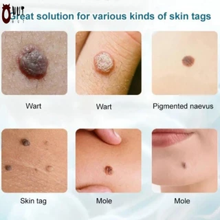 ความแรงสูงสุด Skin Tag Remover Gentle Highly Potent Wart Removal Treatment สําหรับผู้ใหญ่ Natural & Healthy Supplies
