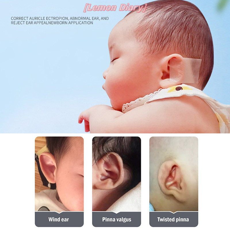 แอลดี| เครื่องแก้ไขหูเด็ก เทปซิลิโคน แผ่นแปะแก้ไขหูทารก ใหม่