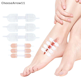 Che Zipper Tie Wound Closure Patch Hemostatic Patch Wound Fast Suture Zipper Band TH