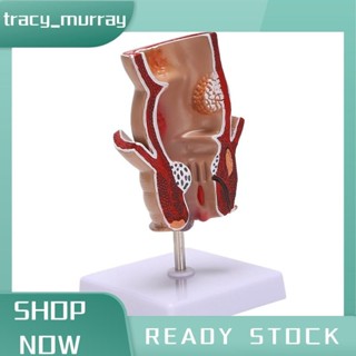 tracy_murray Anatomy รุ่น Human Rectal Hemorrhoid Lesion รุ่…