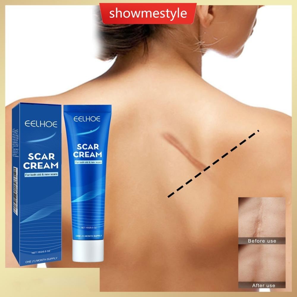 Sms Skin Repair Cream Scar Cream Care สําหรับ Scalds Burn Marks Acne Marks Fading and Smoothing Care Cream Scar Cream N5X5