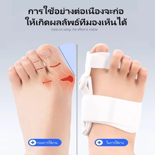 litai อุปกรณ์พยุงนิ้วเท้าแบบ hallux valgus/การแก้ไขนิ้วโป้งเท้าโป้งยื่น/อุปกรณ์แยกนิ้วเท้าแบบสวมรองเท้ายูนิเซ็กซ์