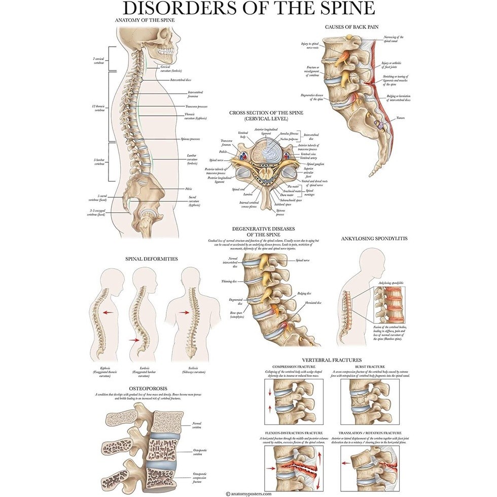 1Pcs Canvas Print Spine Disease Anatomy Poster Layer Pressure Chart Canvas Painting