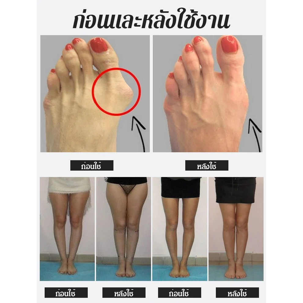 ✨อุปกรณ์พยุงนิ้วเท้าใหญ่แบบตาข่าย Hallux Valgus / อุปกรณ์แก้ข้อเท้าเอียงแบบระบายอากาศ / อุปกรณ์พยุงข้อนิ้วหัวแม่เท้าเอียง / ปลอกแก้ไข Hallux Valgus แบบตาข่าย / อุปกรณ์พยุงข้อเท้าแบบ Comfort Hallux Valgus