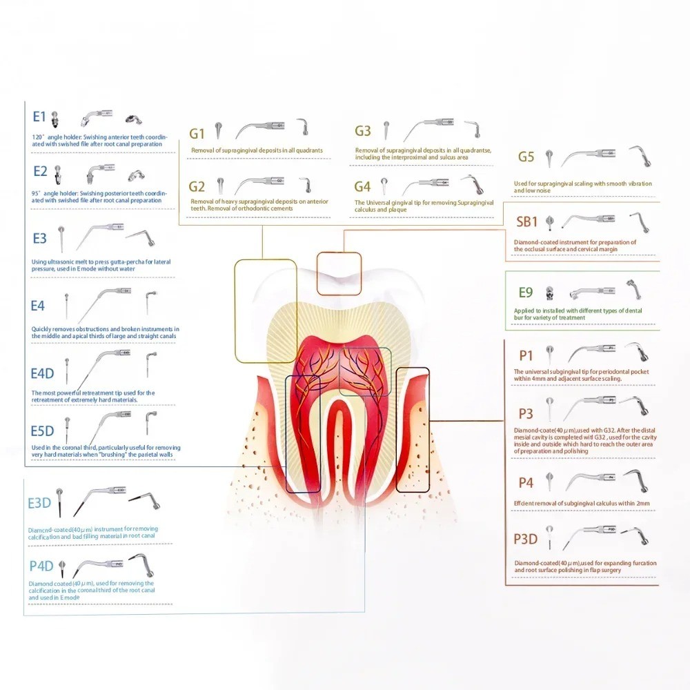 Niceden 5 ชิ้น/แพ็คทันตกรรมนกหัวขวาน G1 G2 G4 P1 Ultrasonic Scaler Scaling เคล็ดลับมือชิ้นไม้-Pecker ทํางานสําหรับทําความสะอาด - รูปที่ 7