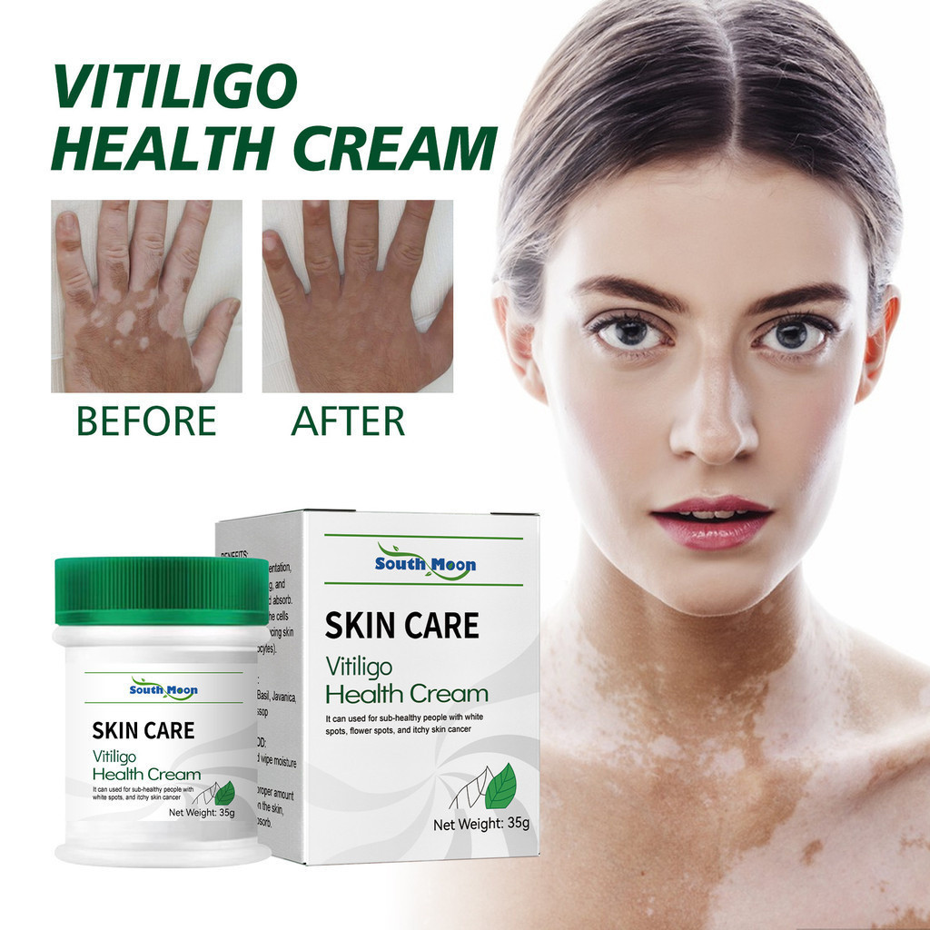 ครีมรักษาผิวหนัง ครีมป้องกันอาการคัน ครีมจุดสีขาว vitiligo ครีมรักษาสุขภาพ vitiligo ครีม vitiligo ให้ความชุ่มชื้นเหงื่อจุดลบ