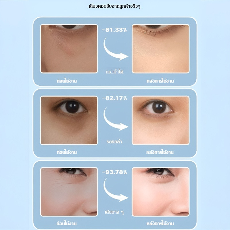 ✅โปร 1 แถม 1 🔥มาร์คเข็ม ไมโครนีเดิลกรดไฮยาลูโรนิค ที่มาร์คตา สำหรับต่อต้านริ้วรอย ริ้วรอยแห่งวัยอันมืดมิด แผ่นเจลให้ความชุ่มชื้นใต้ตา การดูแลผิว อาการบวมของวงกลมสีเข้ม - รูปที่ 4