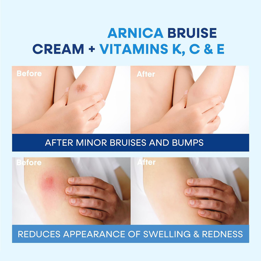 Arnica Bruise Cream Scratch Muscle Soothing Cream วิตามิน K Body Care Cream BRUISECREAMnj818