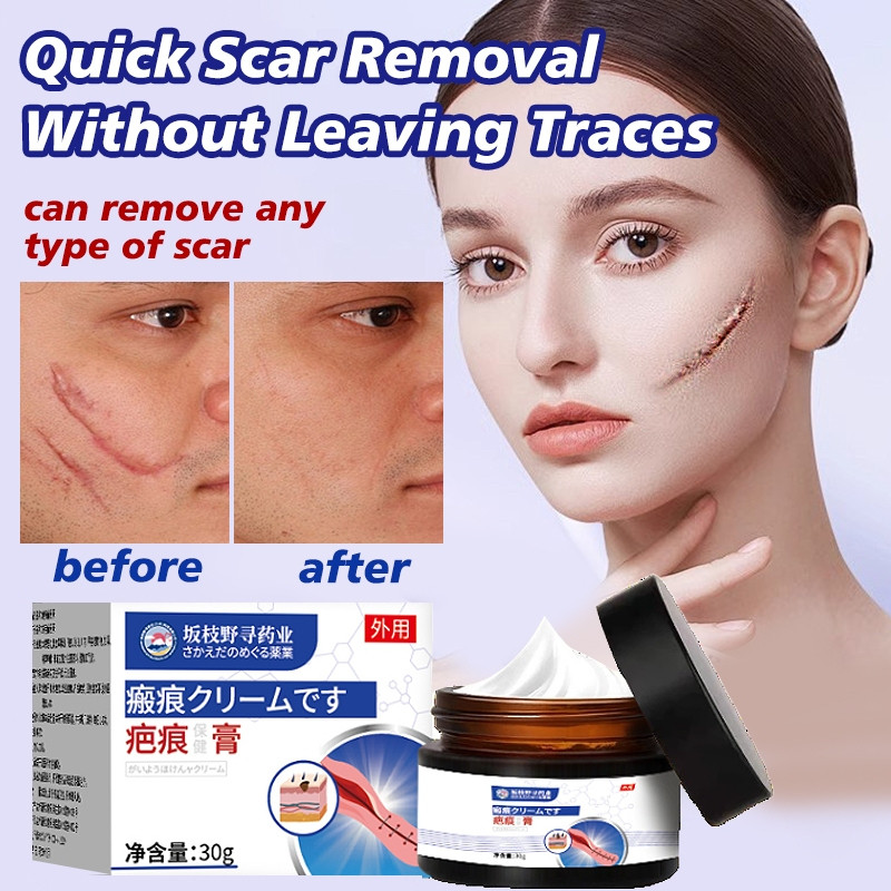 Scar Removal cream 30g ครีมแผลเป็น Keloid Scar Removal Remover รักษาสิว Scar Remover Cream Stretch M