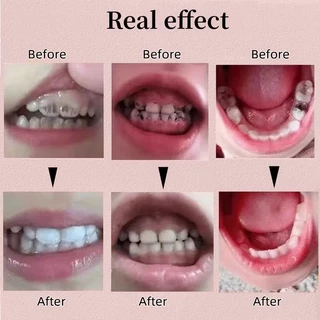 สเปรย์ป้องกันฟันผุ ปกป้องฟันของเด็ก เหมาะสำหรับเด็กอายุ 1-12 ปี Tooth Spray Children Baby Tooth Cleaning