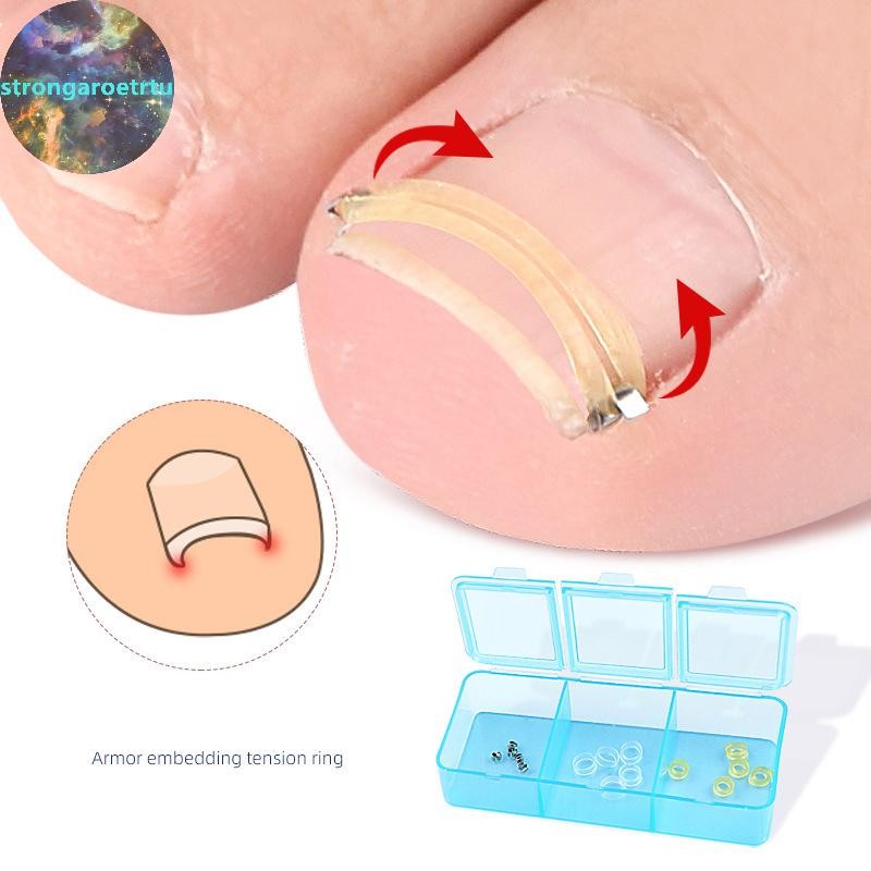 Strongaroetrtu คุด Toenail Corrector Pedicure กู้คืน Embed Toe Nail Treatment Foot Correction Patch สติกเกอร์ Care เครื่องมือ TH