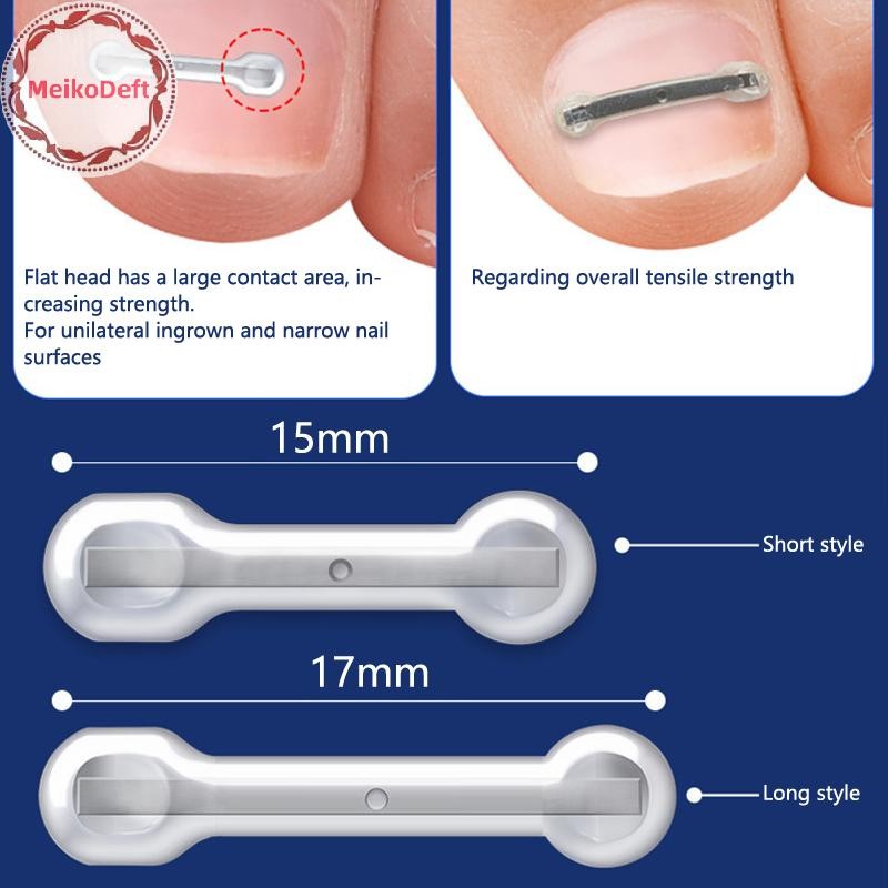MeikoDeft 6/12pcs คุด Toenail Corrector เครื่องมือคุด Toe Nail Treatment Elastic Patch สติกเกอร์ Straightening คลิปรั้ง Pedicure เครื่องมือ TH
