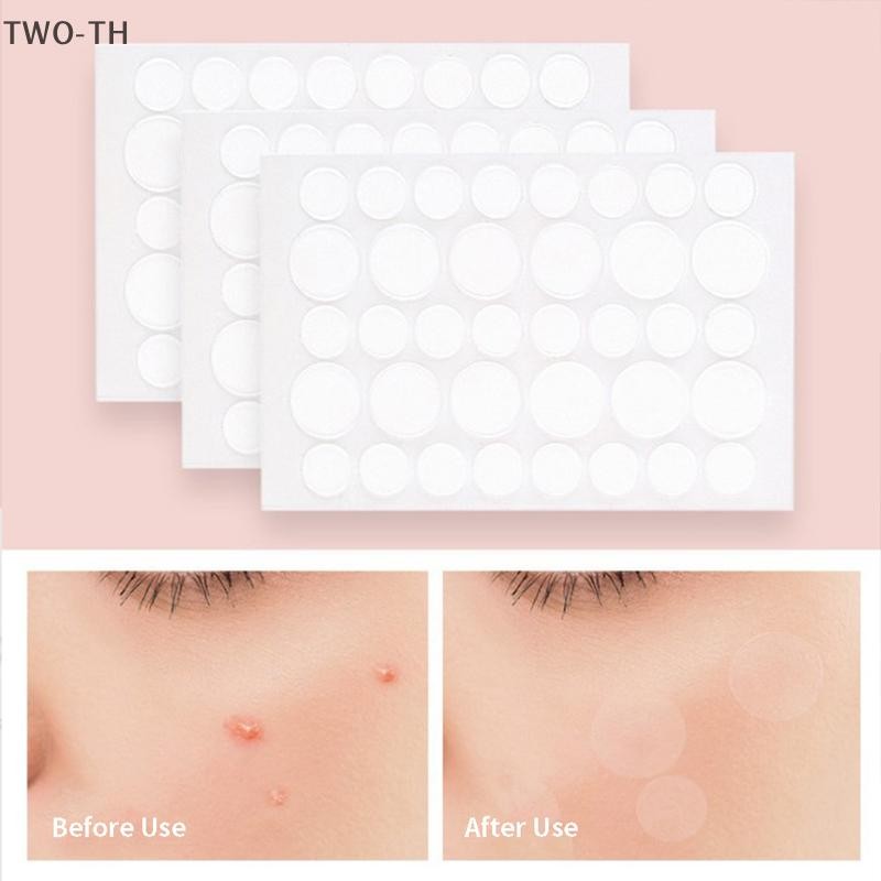 TWO-TH สิว Pimple Patch สติกเกอร์ Pimple Remover เครื่องมือดูดซับ Pus และ Oil Acne Patch ใหม่