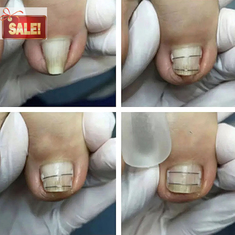 Bl คุด Toenail Corrector เครื่องมือ Pedicure Recovered Toe Nail Treatment Professional คุด Toenail Straightening คลิปรั้ง A