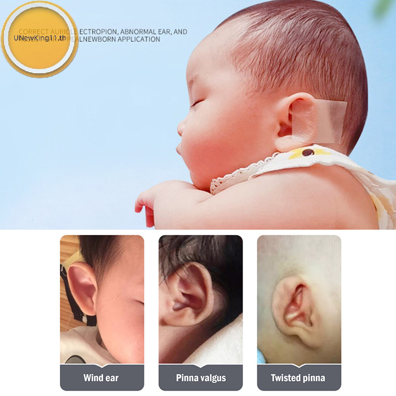 Unewking Baby Ear Correctors เทปซิลิโคน แผ่นแปะแก้ไขหูสําหรับทารก th