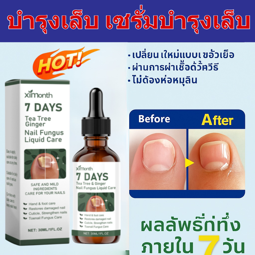 💯💯น้ำยารักษาเชื้อราที่เล็บ แก้เล็บขบ เล็บหนาเสียจากเชื้อรา ฟื้นฟูเล็บให้นุ่มสวยแข็งแรง ซ่อมแซมเล็บแตก กำจัดเล็บเสีย ขายดีในไทย