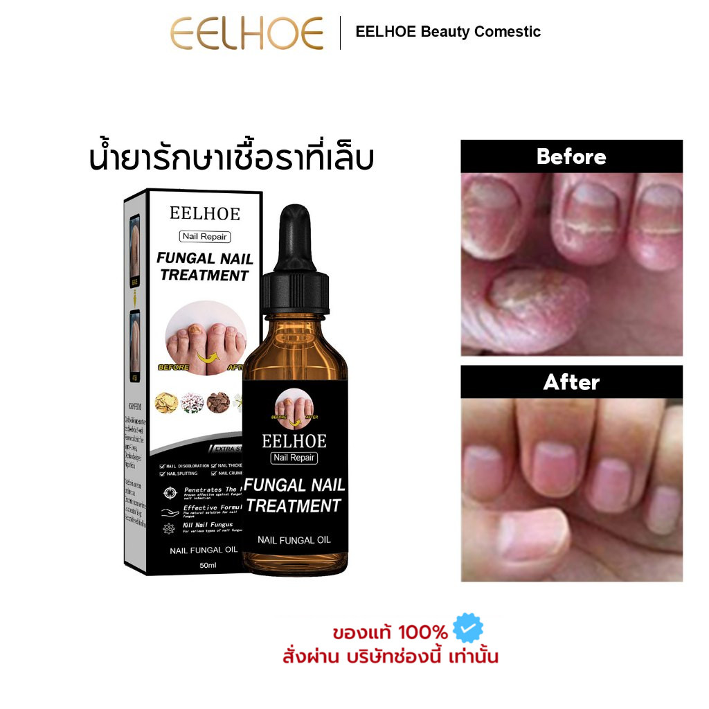 EELHOE น้ำยารักษาเชื้อราที่เล็บ น้ำยาซ่อมแซมเล็บเหลือง น้ำยารักษาเล็บ กำจัดเล็บเสีย ซ่อมแซมเล็บแตก