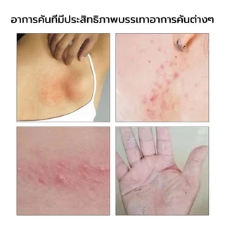 🔥พร้อมส่ง🔥 ครีมZDF เนื้อครีมสีชมพู ขนาด15g ทาสะเก็ดเงิน ผิวหนังอักเสบ ติดเชื้อรา สะเก็ดเงิน แบคทีเรีย คัน ครีมแก้คัน