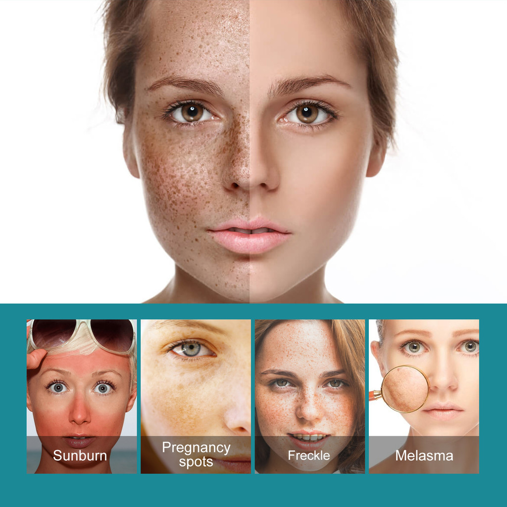 EELHOE Whitening Spot Cream Moisturizing Moisturizing Skin Fade Spots Acne Whitening Brightening Rej