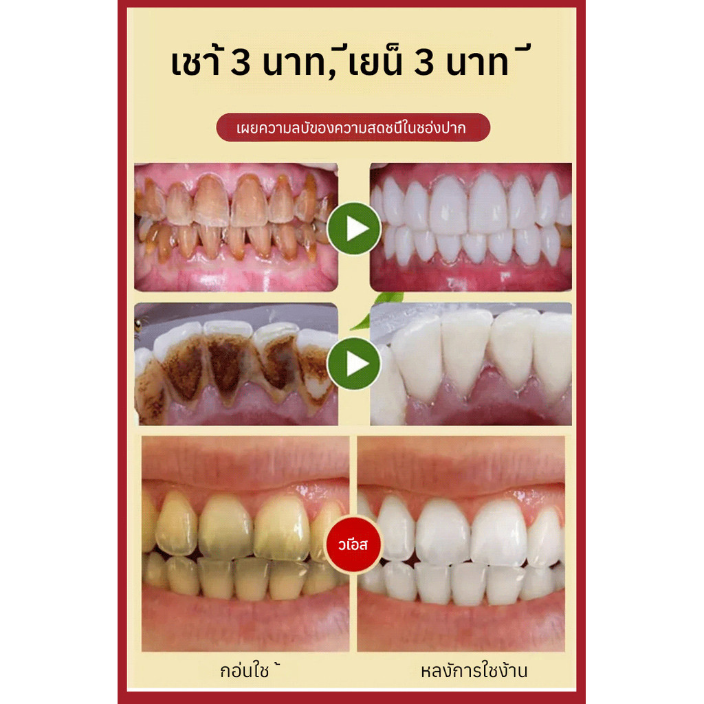 🦷1แถม1🦷ยาสีฟันโปรไบโอติก SP10 ฟอกฟันขาวทันใจ ลดกลิ่นปาก ดูแลช่องปาก Whitening Toothpaste ลดหินปูน ลดคราบเหลืองจากชา/กาแฟ เหนือกว่าการขูดหินปูน 24Hพร้อมส่งในไทย - รูปที่ 5
