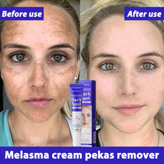 ครีมสําหรับ เมลาสมา dark spot Remover melasma removal cream …