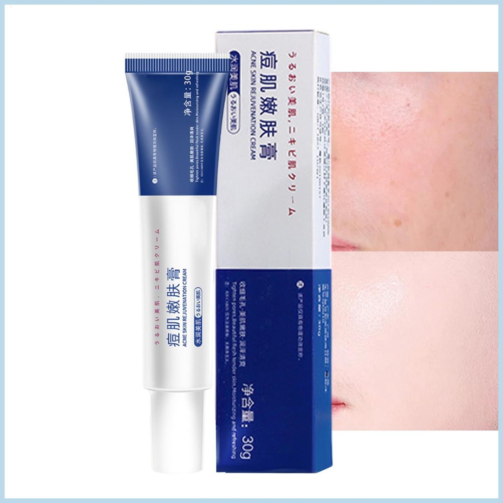 Anti Pimple Face Cream Anti Pimple Care Oil Control Ointment เครื่องมือซ่อมแซมผิวสําหรับ Dry Oily Se