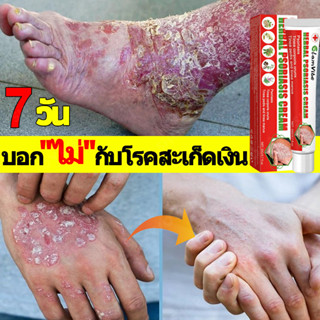 ครีมแก้คัน, ครีมเชื้อรา, ครีมสะเก็ดเงิน, สะเก็ดเงิน, เชื้อรา…