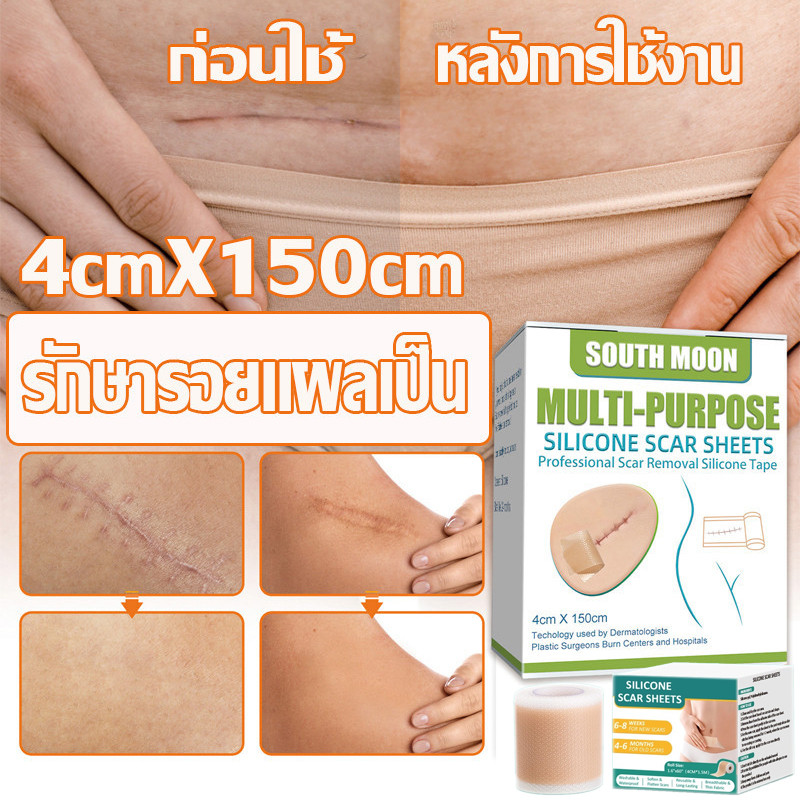 พร้อมส่ง รักษารอยแผลเป็น แผ่นแปะแผลเป็น 4cm*150cm แผ่นปิดรอยแผลเป็น กําจัดรอยแผลเป็นจากแผลเ ลบรอยแผลเป็นแผลผ่าตัด