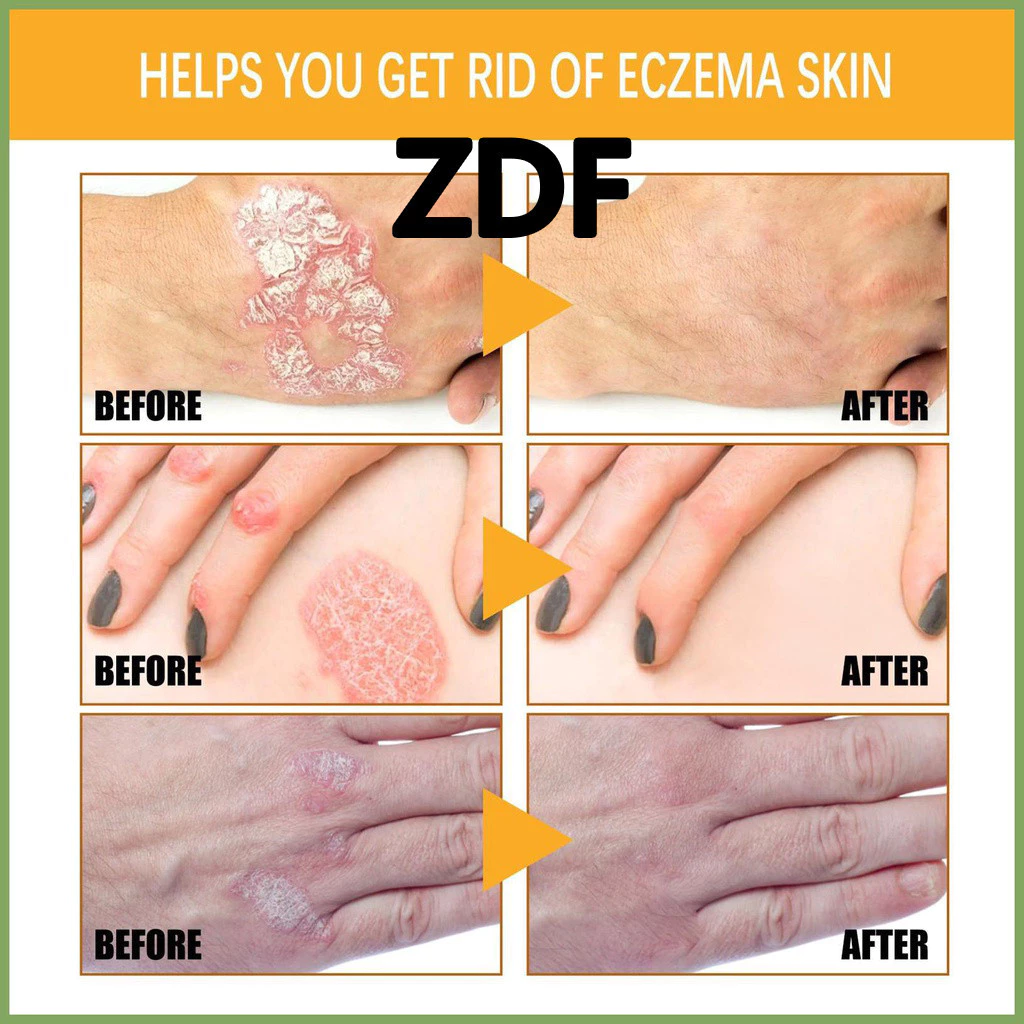 ZDF ครีมดูแลสะเก็ดเงิน บรรเทาอาการคันและแดง thumbnail 3