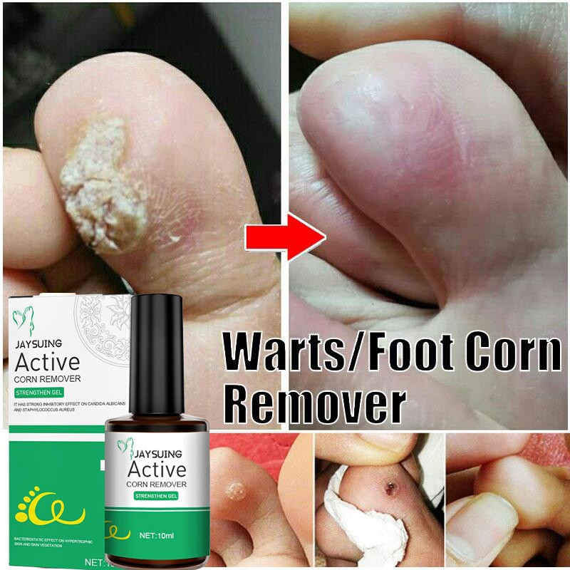 มีประสิทธิภาพลบเท้าข้าวโพด Care Cream ลบแคลลัสเท้าลบ Warts Smooth Skin Mild Wart Removal Corns Foot 