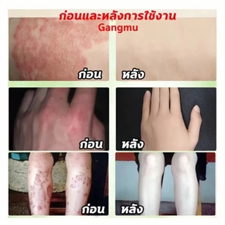 🔥Creamถูกที่สุด!🔥พร้อมส่ง ขนาด15g ของแท้! Cream กลากเกลื้อน เชื้อรา ผิวอักเสบ โรคผิวหนัง สะเก็ดเงิน หลอด