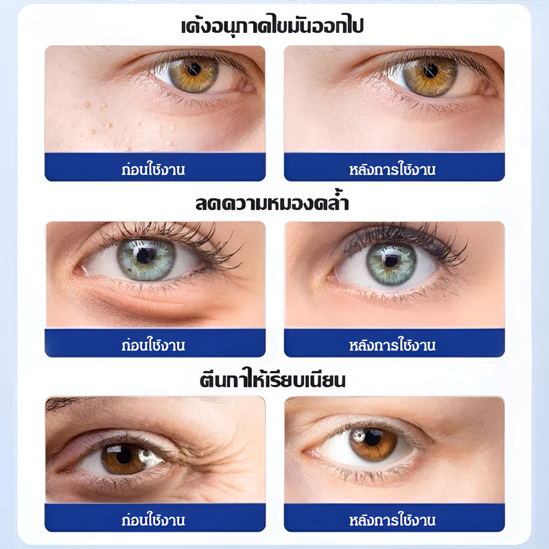 ✅โปร 1 แถม 1 🔥มาร์คเข็ม ไมโครนีเดิลกรดไฮยาลูโรนิค ที่มาร์คตา สำหรับต่อต้านริ้วรอย ริ้วรอยแห่งวัยอันมืดมิด แผ่นเจลให้ความชุ่มชื้นใต้ตา การดูแลผิว อาการบวมของวงกลมสีเข้ม - รูปที่ 3