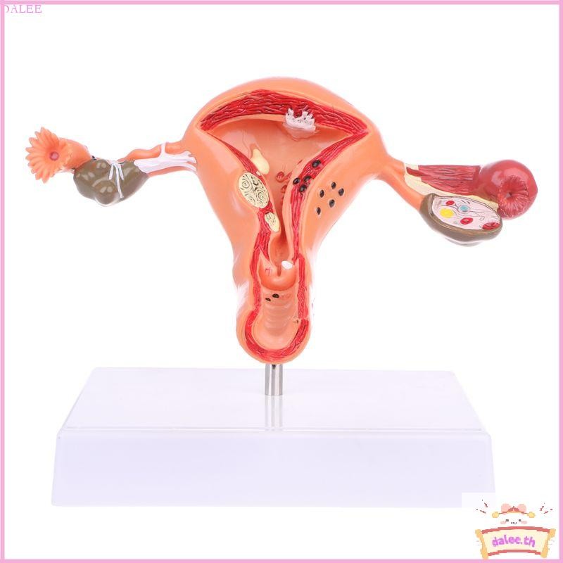 DALE มดลูกทางพยาธิวิทยา Ovary Anatomical Model Anatomy สําหรับเครื่องมือศึกษาส่วนข้าม