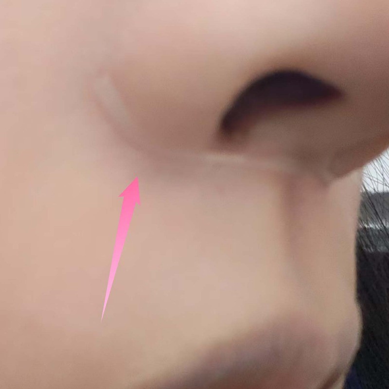แผ่นแปะจมูกที่มองไม่เห็น 60 ชิ้น – Adhesion กันน้ําและกันเหงื่อ, การออกแบบระบายอากาศโปร่งใสสําหรับใช้ทุกวัน/กีฬา, สารละลายสร้างจมูกทันที ราคา ถูกที่สุด ดีลบีเคเค แกลเลอรีภาพที่ 4