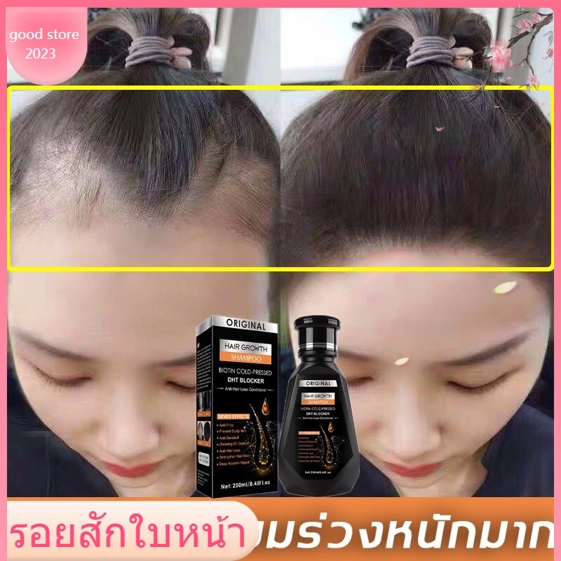 จัดส่งท้องถิ่น🎀น้ํามันหอมระเหยการเจริญเติบโตของเส้นผม ไบโอติน เย็น-กด DHT Blocker และแชมพูปลูกผม ครีมนวดผมป้องกันผมร่วง