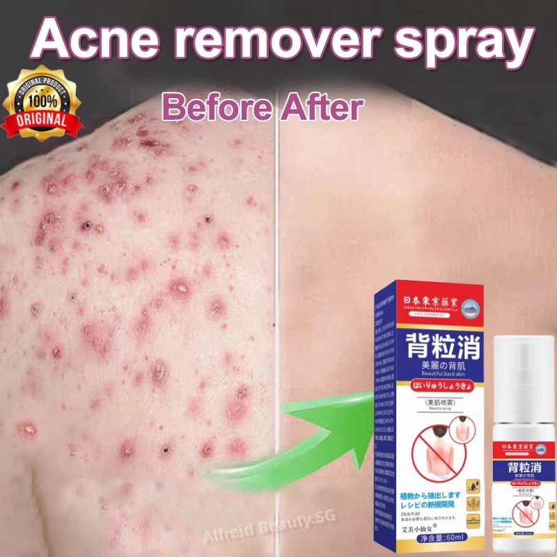 Japan Back Acne Spray Anti Mite Acne Pimple Treatment Antibiotic Exfoliating Chicken Skin