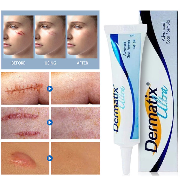 Dermatix Ultra Gel ยาทาแผลเป็น ลดแผลเป็น รอยสิว แผลไฟไหม้ รอยแผลเป็นจากการผ่าตัด ครีมทาแผลเป็น 15g