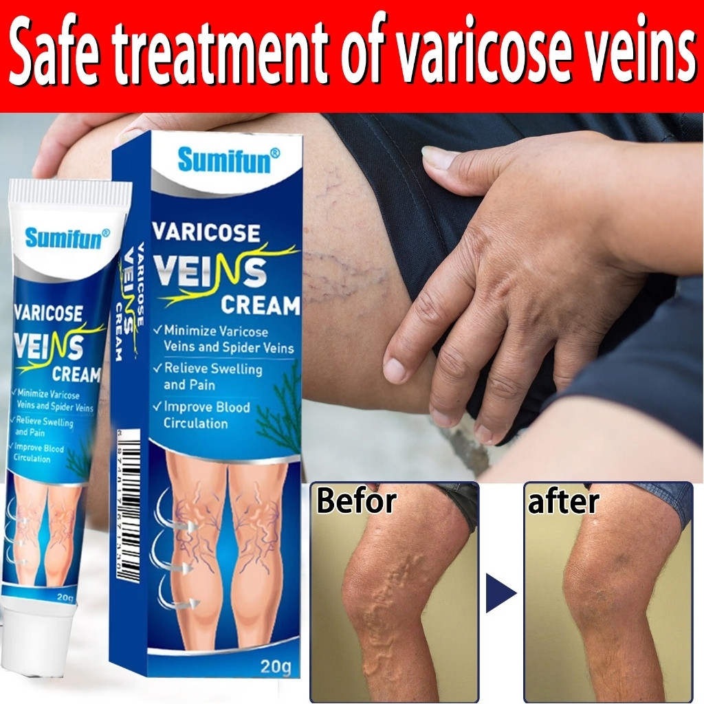 Varecose Vein Remover ครีมเส้นเลือดขอดดั้งเดิม Varecose Intravenous Cream ครีมหลอดเลือดดํา