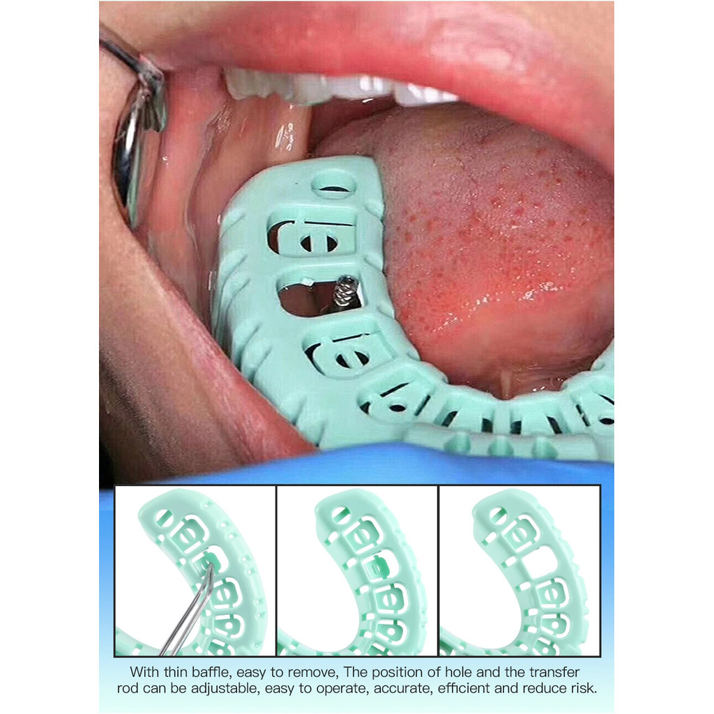 Denspay 6 ชิ้น/เซ็ตทันตกรรม Impression ถาดพลาสติก S/M/L ทันตกรรม Implant ถาดเต็มปากที่ถอดออกได้บางส่วนแม่พิมพ์ถาดง่ายพับ ราคา ถูกที่สุด ดีลบีเคเค แกลเลอรีภาพที่ 8