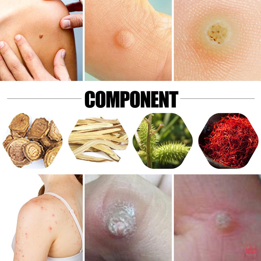 Foot Corn Removal Bandages สูตรอ่อนโยน Warts Thorn Detox Patch สําหรับทุกสภาพผิว Foot Care